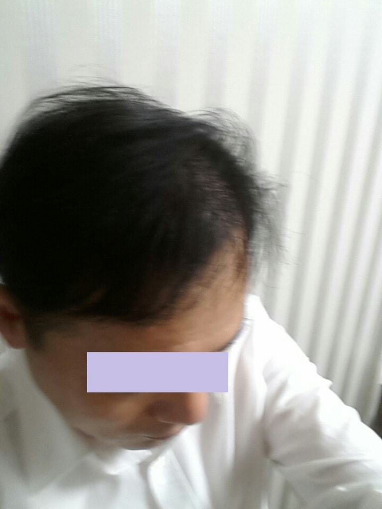 수술후18개월03.jpg