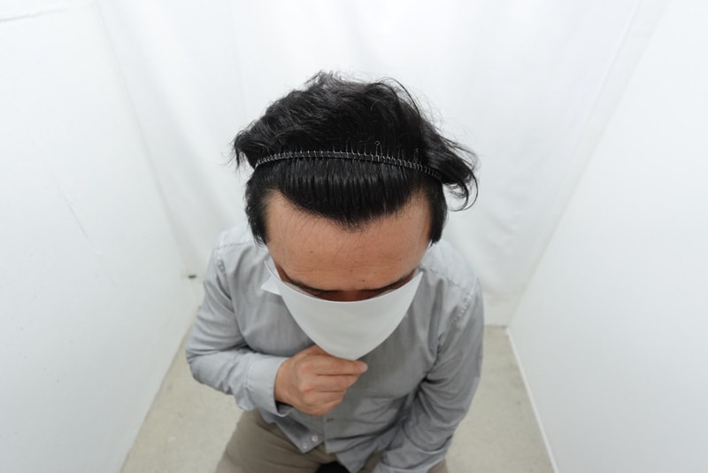 자라다 의원 수술 후기(8개월)/비삭발/3030모낭
