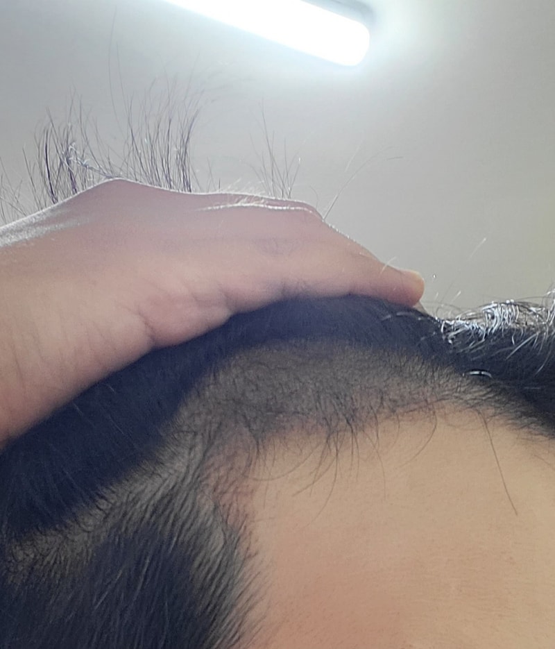 毛发移植的第3个月后期