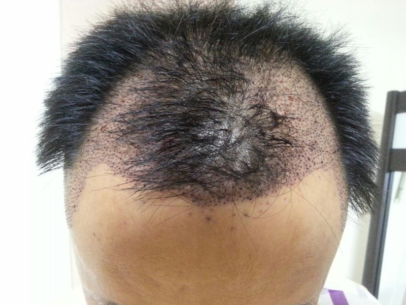 I'm done with a transplant..Now... 14th day..