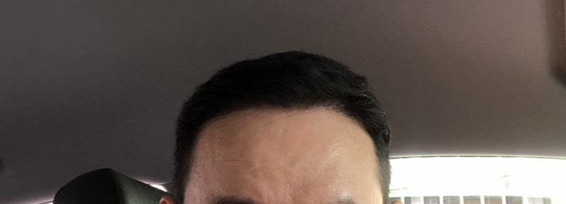 다나 400모낭 as후기