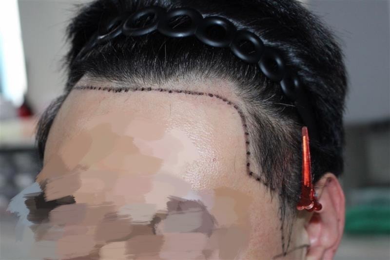 신사 모다올의원 양유군 원장님 1900모 비절개 후기