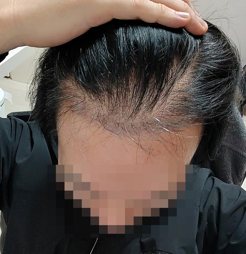 Non-cutaneous hair transplant 3,000 hair 3 months later