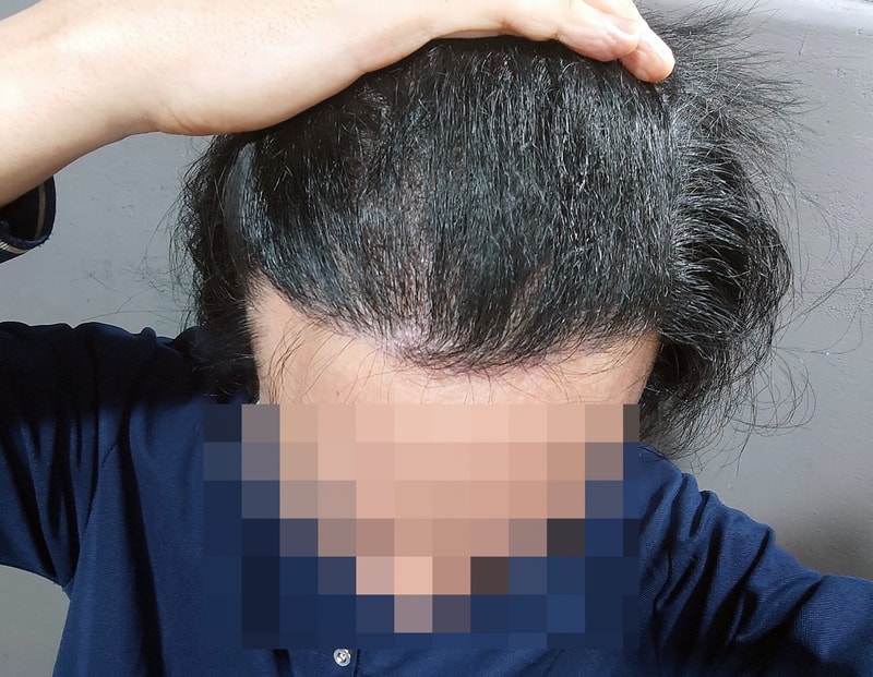 모발이식8개월차02.jpg