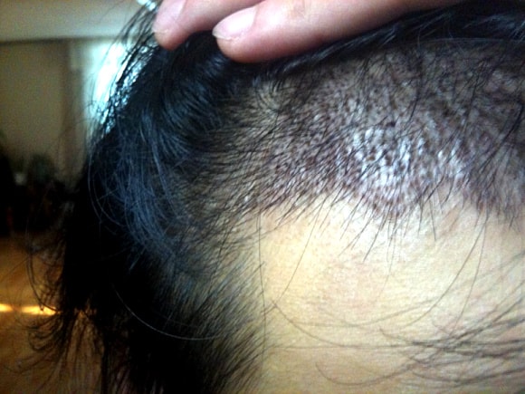Day 8 of New Hair Hair Transplantation