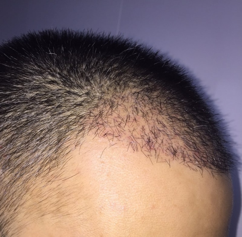It has been 4 weeks since the non-cut 2000 hair follicles.