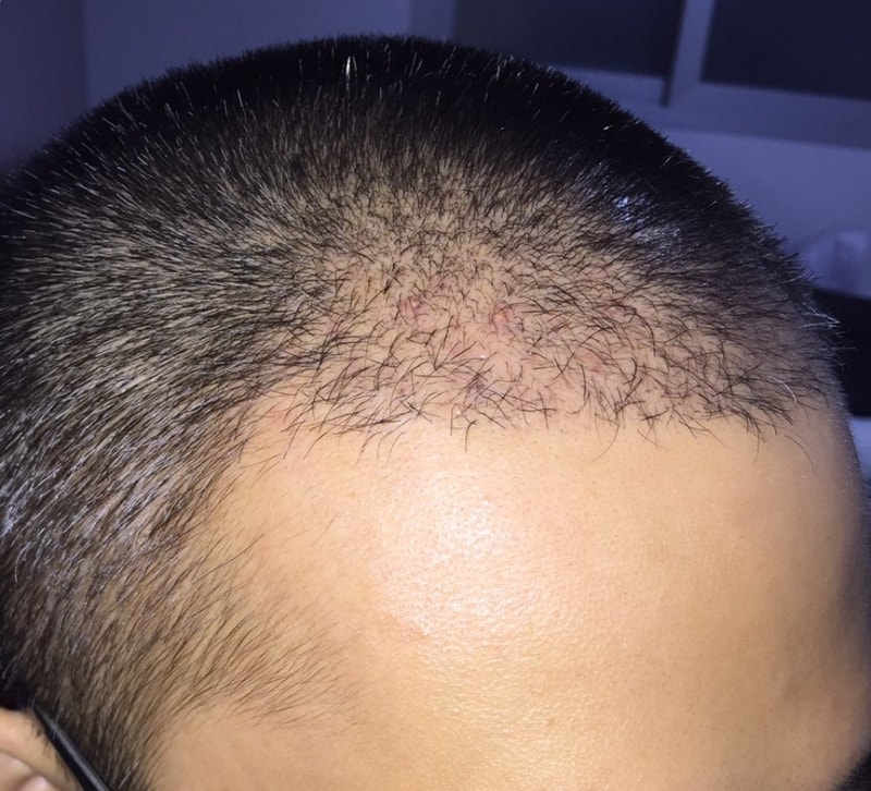 Non-cut 2000 hair follicles 101 days have elapsed.