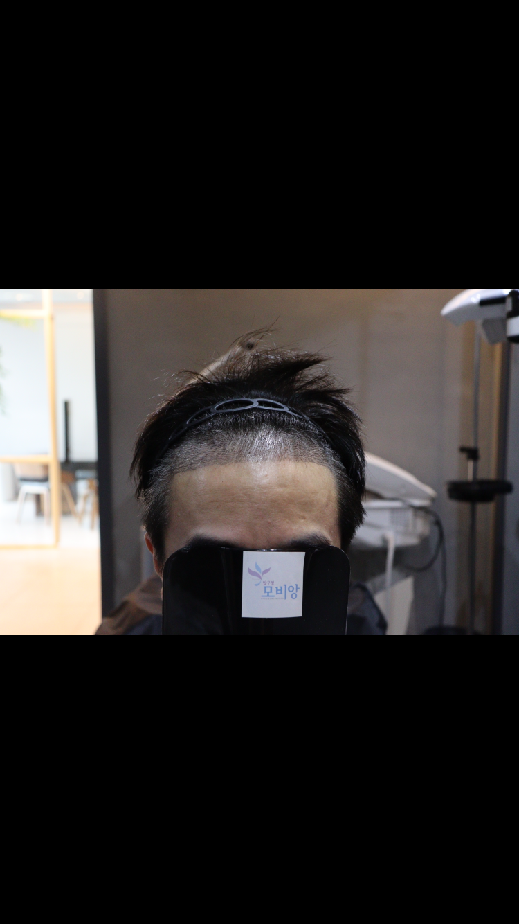 모발이식 1750모낭 2주차 후기