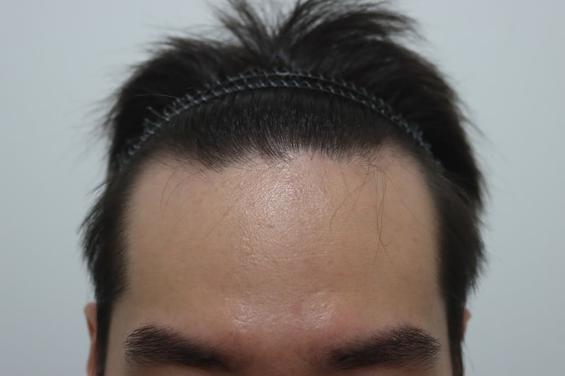 수술전.jpg