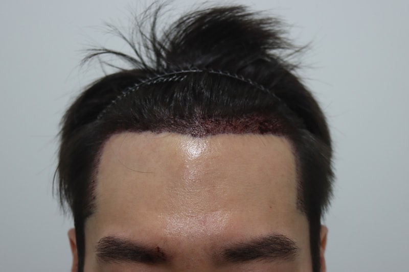 수술후.jpg