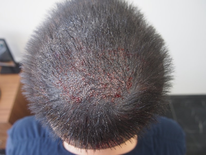 頭頂部1000毛包手術直後の写真です。