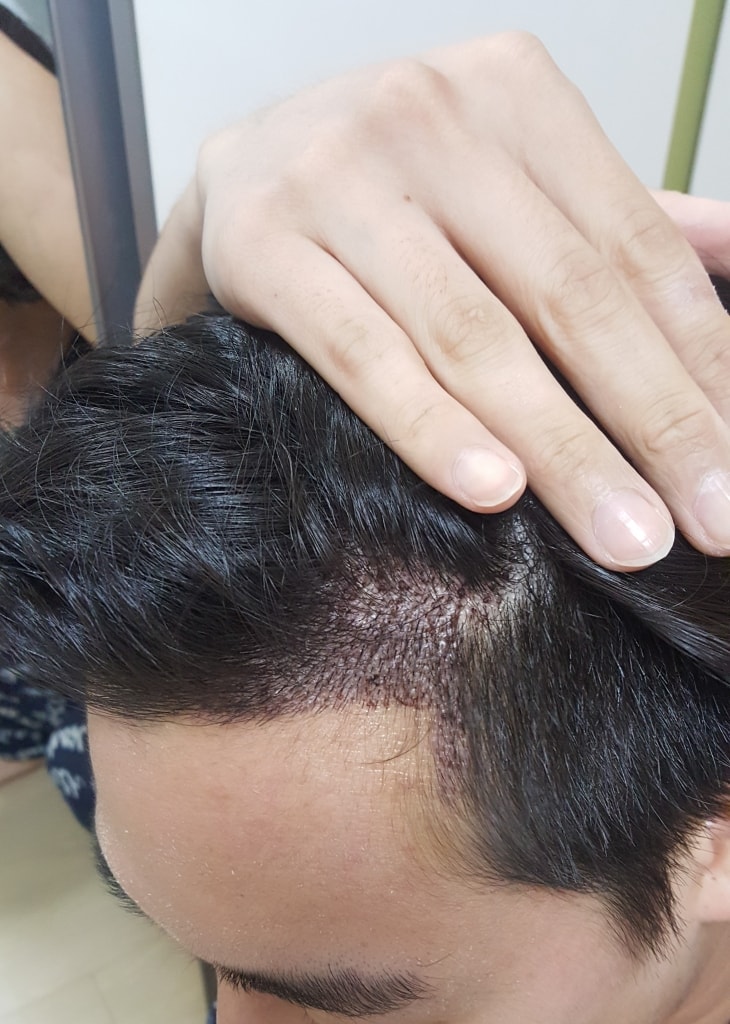 非切开1年+修复4个月后