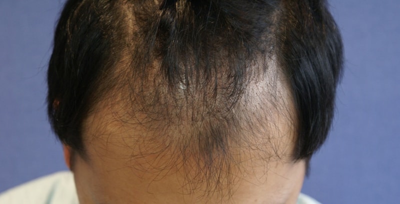 ㅅ제거 I removed the scab for 17 days.
