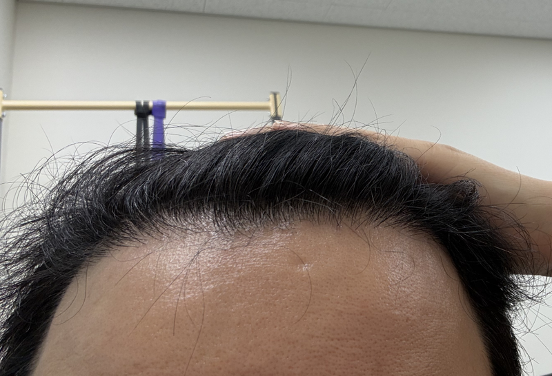 第9个月植发后记