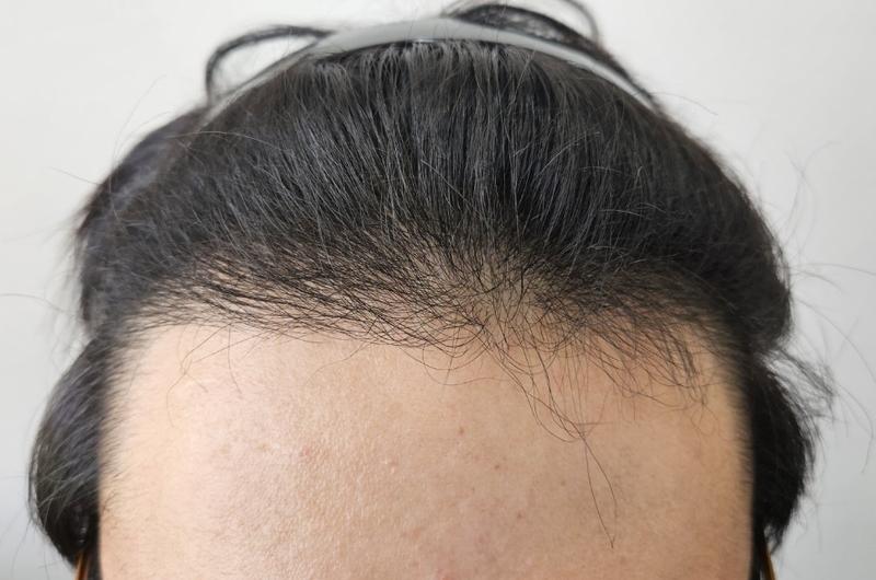 母材性整形外科の毛髪移植4ヶ月目のレビューです。
