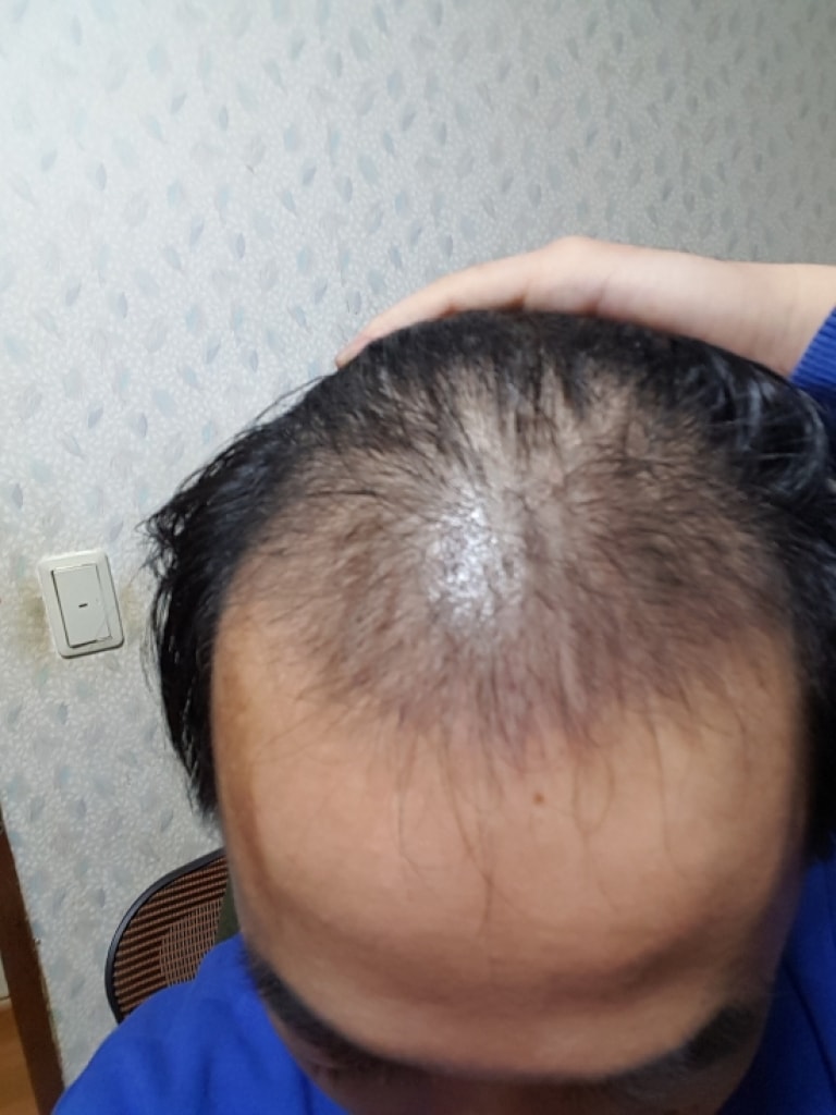 절개 약 4200모 수술후 3개월 후기입니다