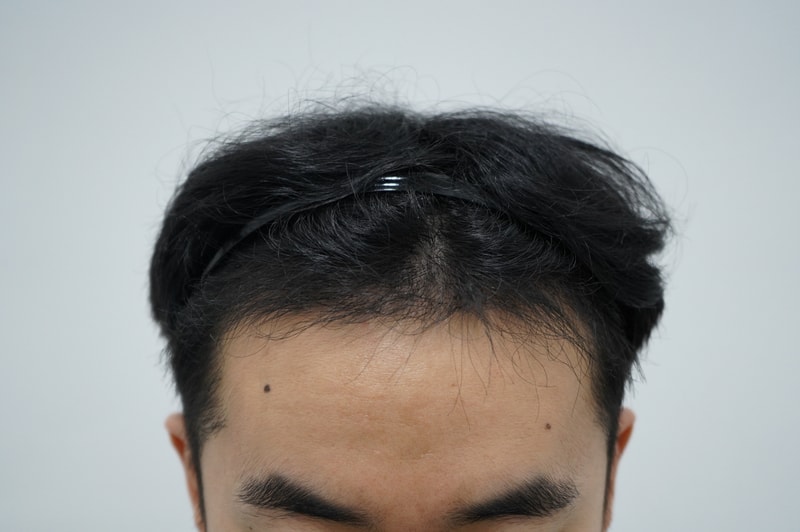 비절개 수술 5개월 후기