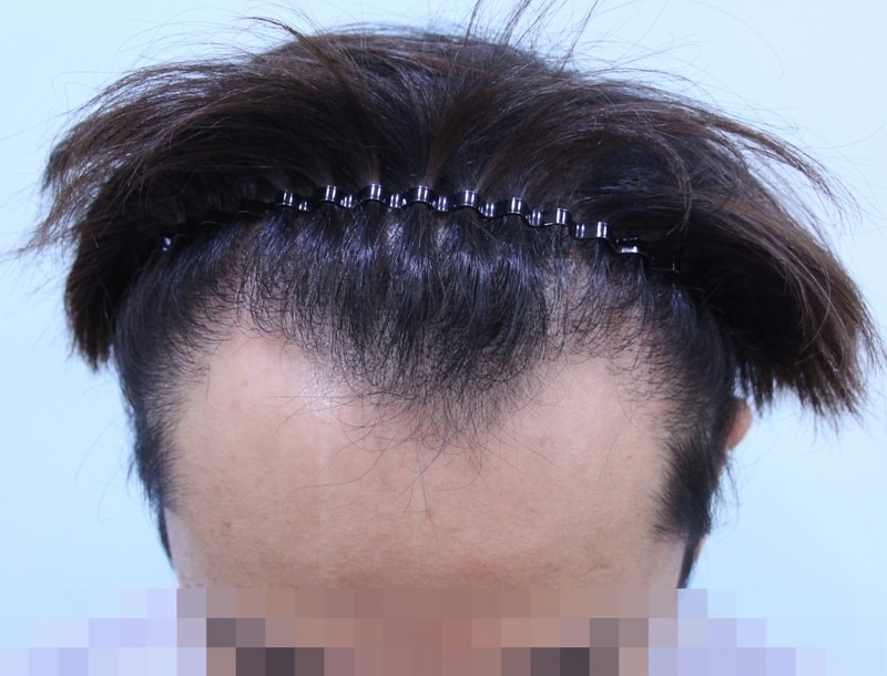 非切開毛髪移植後のレビューです。