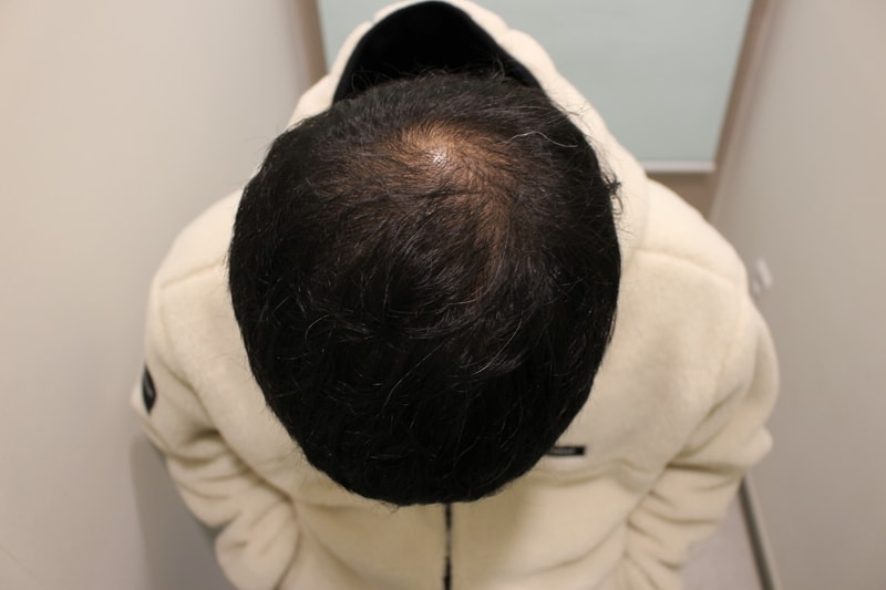 수술후4개월1.JPG.jpg