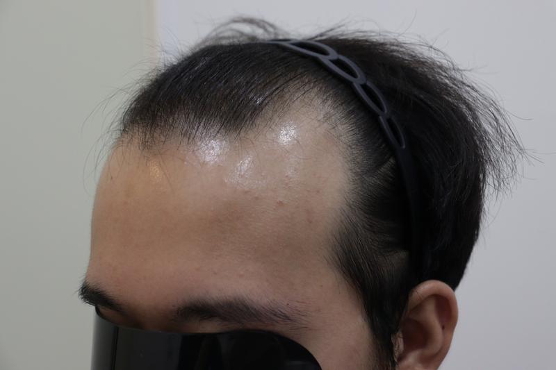 光州狎鴎亭モビアン医院毛髪移植2週目の結果