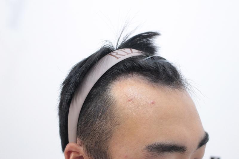 부산리즈모의원 8개월 경과