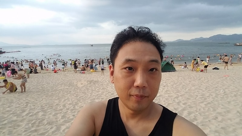 중국에서 모발이식 성공적입니다