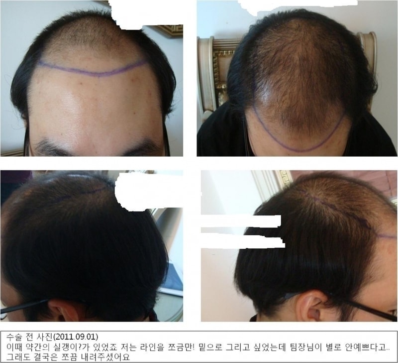 포맷변환_수술전.jpg
