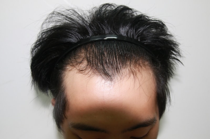Forehead hair transplant (25th day)