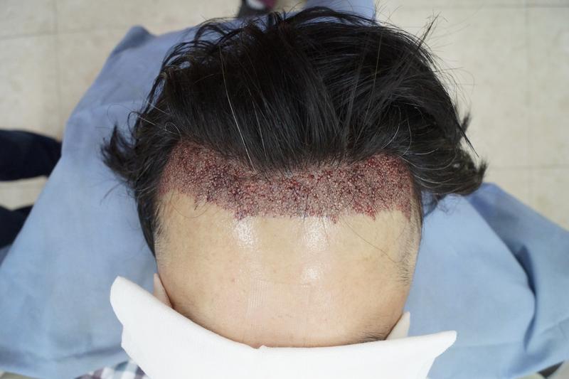 I don't think the transplant hair will be eliminated like in the first round.
