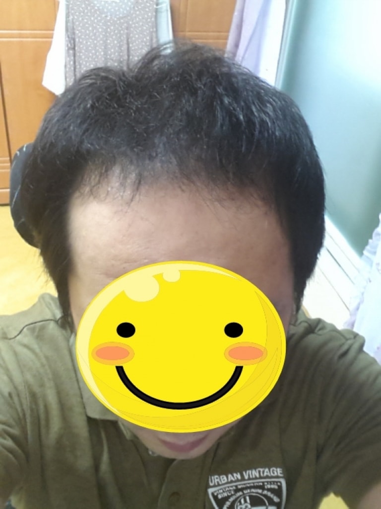 모발이식전.jpg