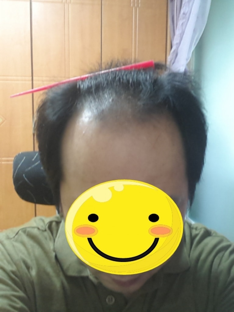 모발이식전1.jpg