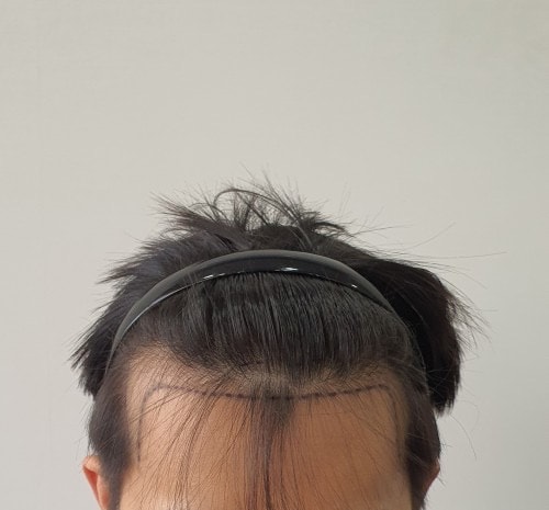 8개월차 경과입니다.