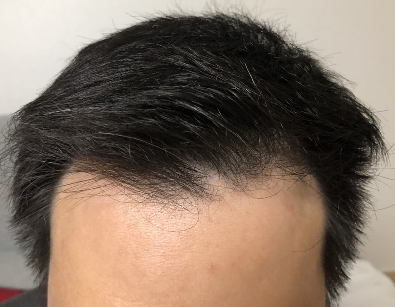 M자형 수술 후 7일째!! 어떤가요