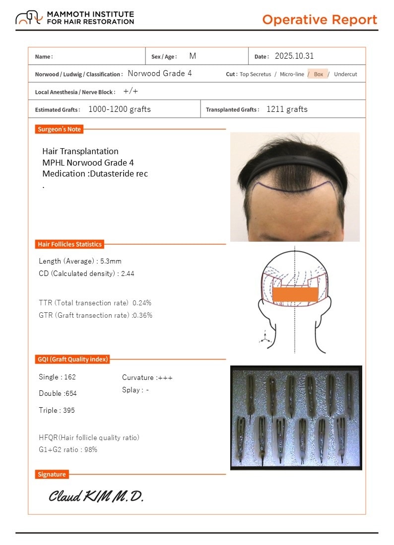 부산모발이식 슬릿방식 맘모스 M자 수술 당일 후기