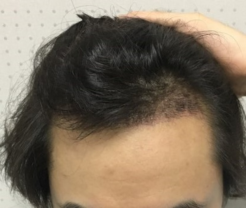 1000모낭 수술 암흑기 초입기 평가 시작
