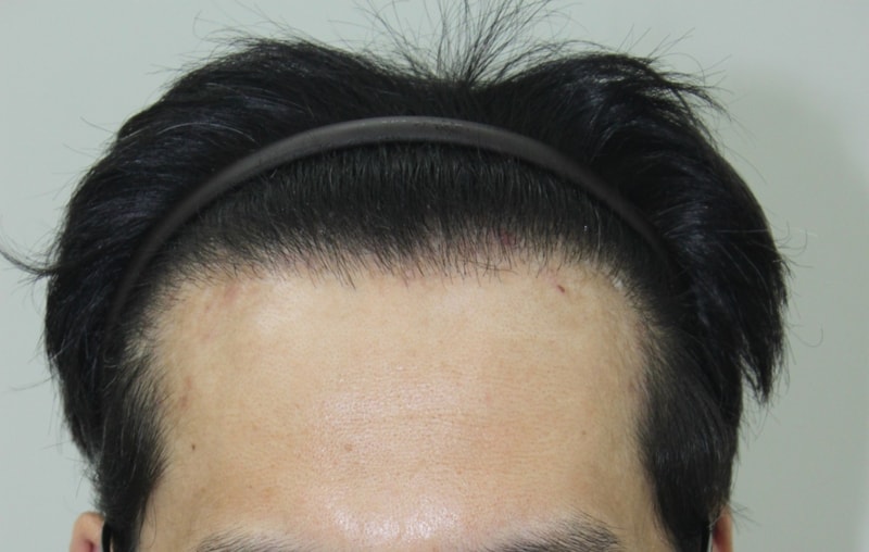 非切開再手術9ヵ月目です