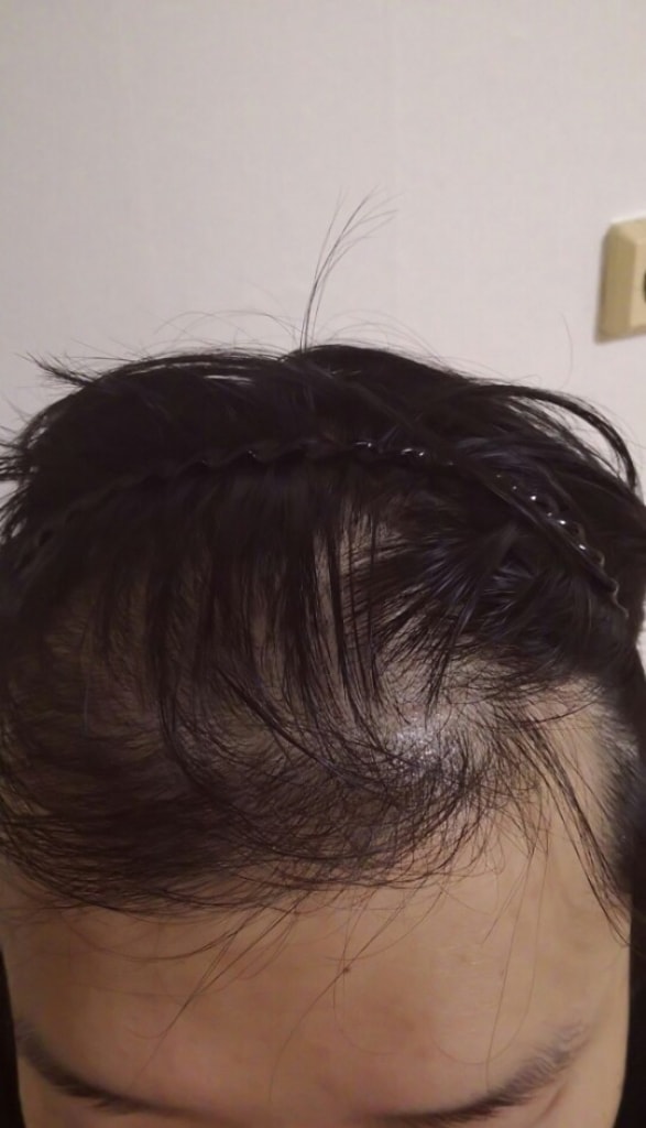 我也做了毛发移植 1200 毛囊非切开