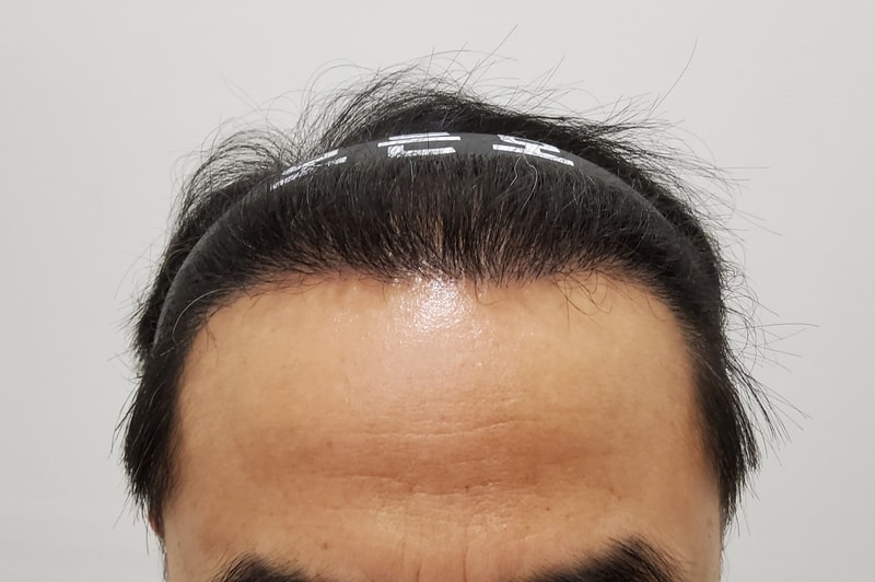 4. 수술후_6개월_1.jpg