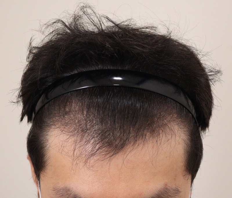 Hello members! I'm leaving a review of my hair transplant for 6 months.