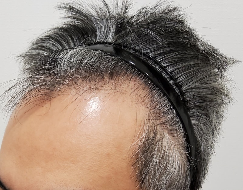 1. 수술전_2.jpg