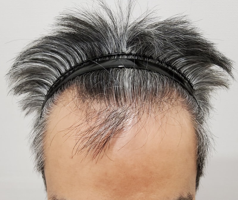 非切開毛髪移植。 昨日もらってきました。 レビューを残します。
