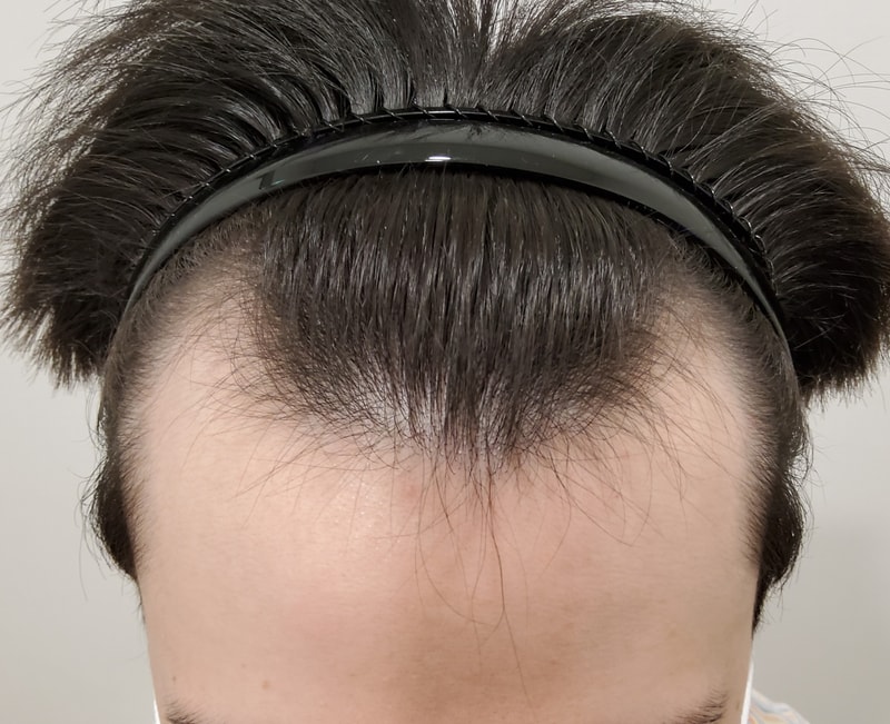 Hair transplant 2800 Mo's 1st day left ^^