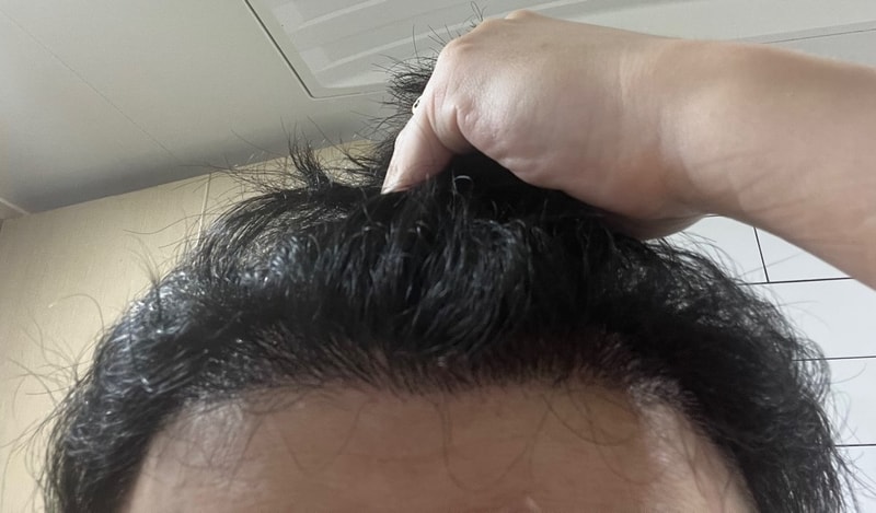 4. 수술후_6개월_셀카1.jpg