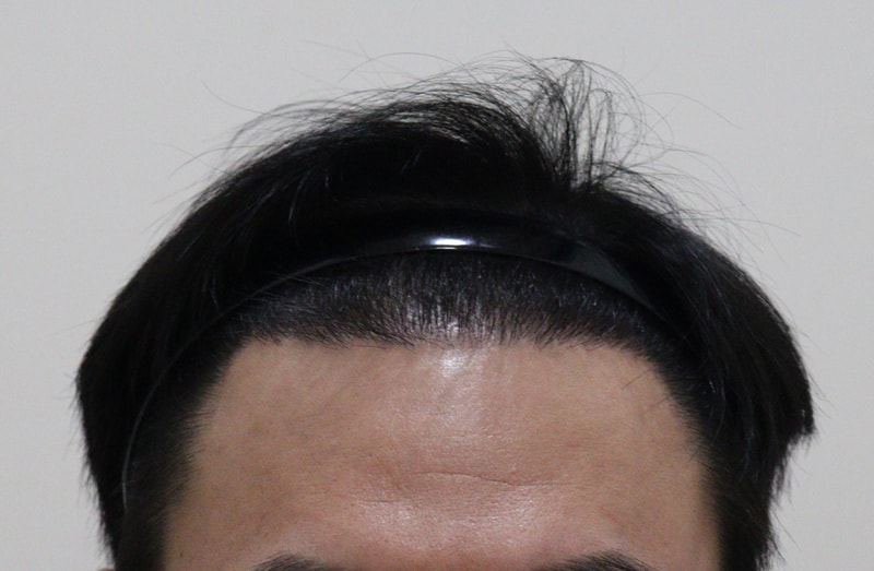 3. 수술후_6개월_1.JPG