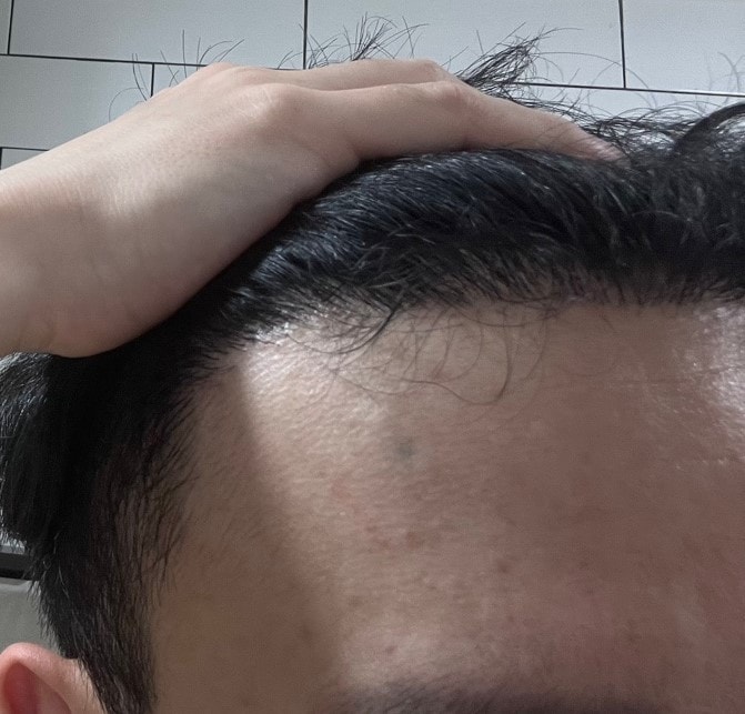 4. 수술후_6개월_셀카2.jpg