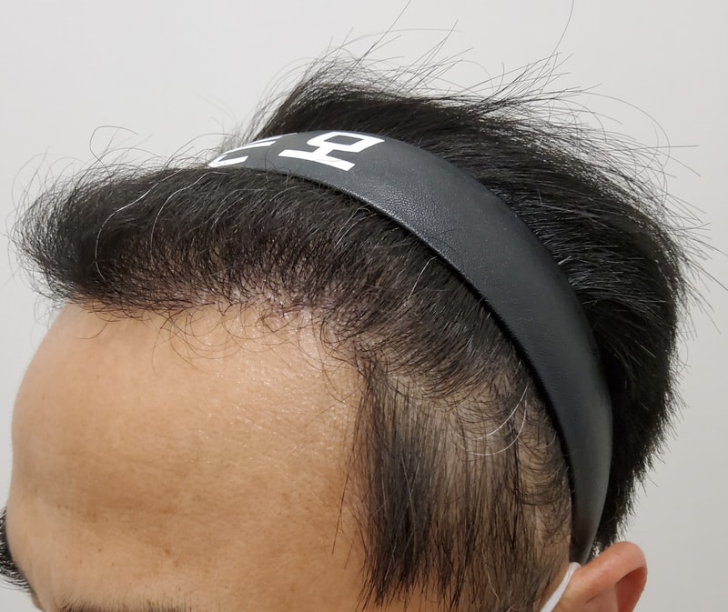 4. 수술후_6개월_2.jpg