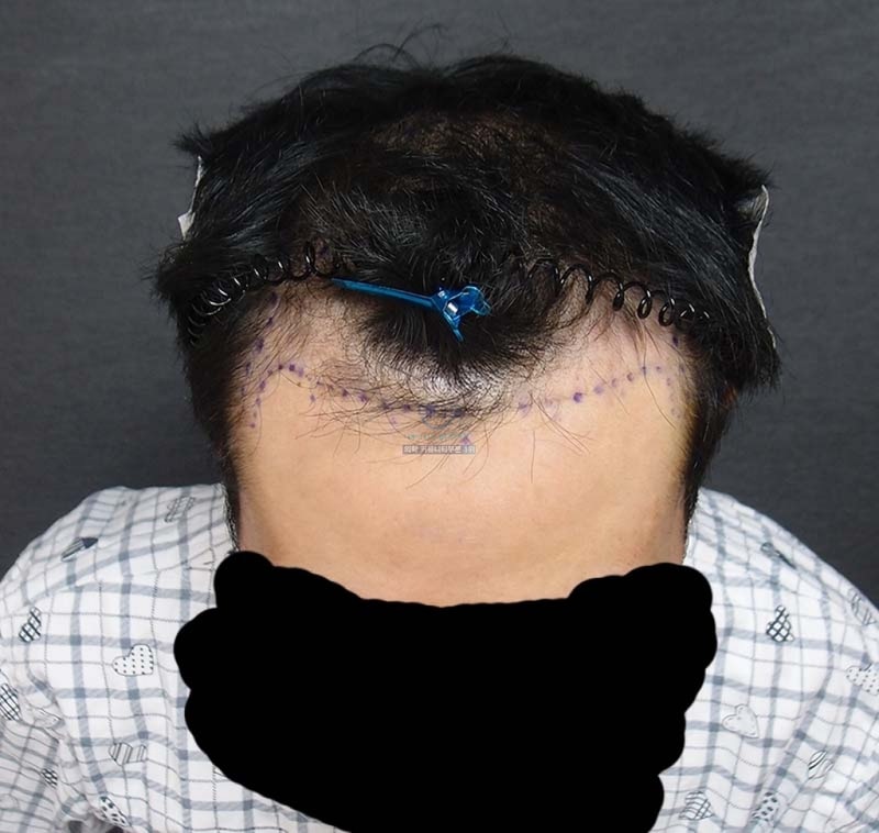 수술전.jpg