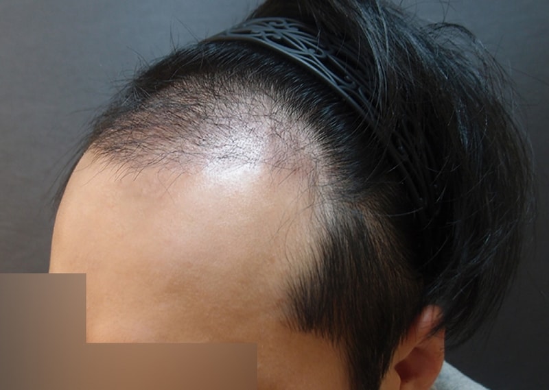수술후3개월02.jpg