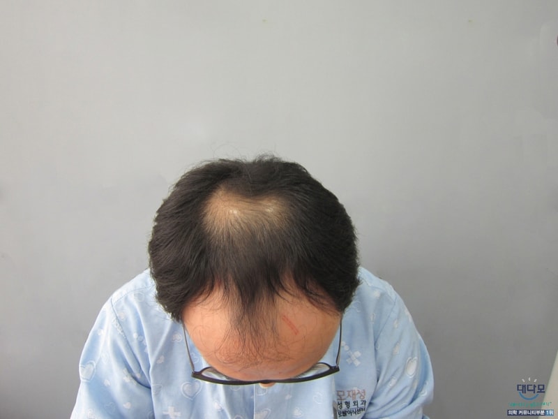 비절개 3600모낭 14개월 경과입니다