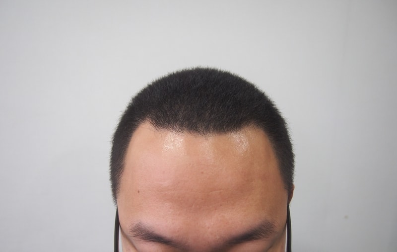 毛材性 1400 毛囊手术前/手术第1天